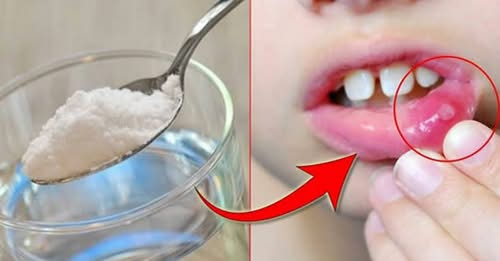 How to Cure Mouth Ulcers in Minutes and Naturally