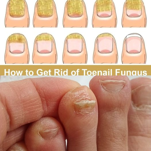 How to Get Rid of Toenail Fungus Fast and Naturally