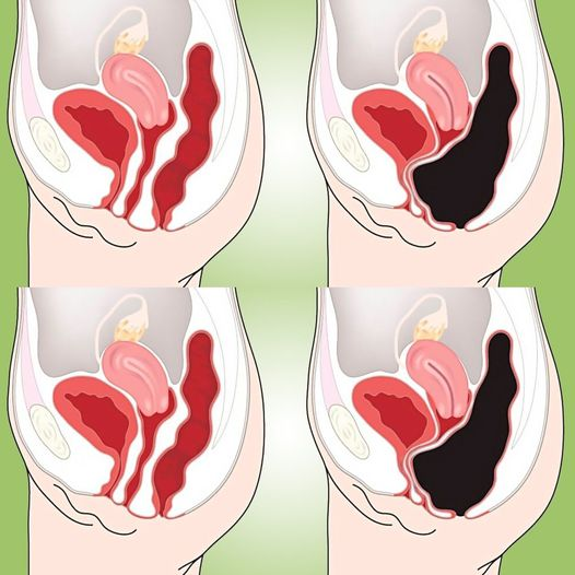 The Natural Way to Cleanse Your Colon at Home