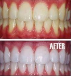 How to whiten your brown teeth in 3 minutes