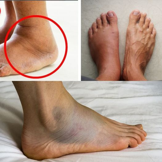 The Power of Vitamin B6: A Natural Solution for Reducing Swelling in Legs and Feet